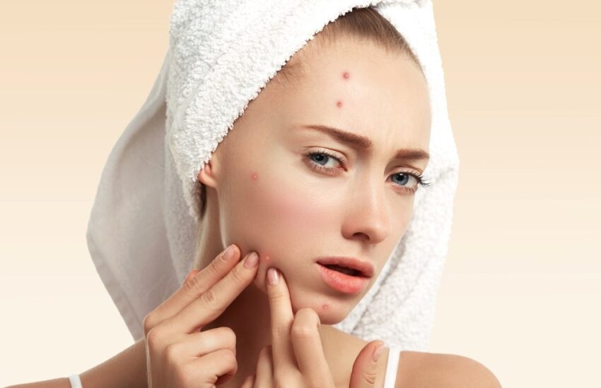how-to-get-rid-of-pimples
